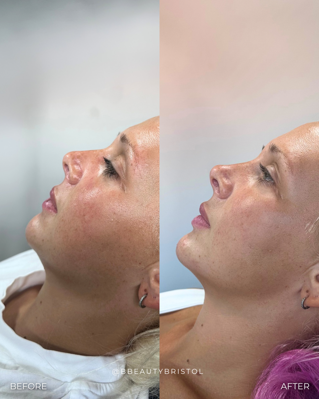 Before and after comparison of a woman's neck with visible skin texture improvement.