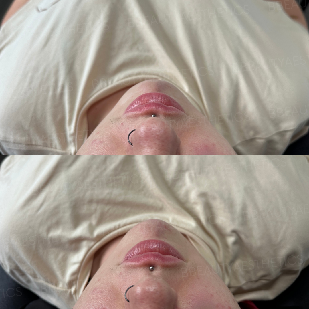 Before and after of a chin enhancement using dermal filler.