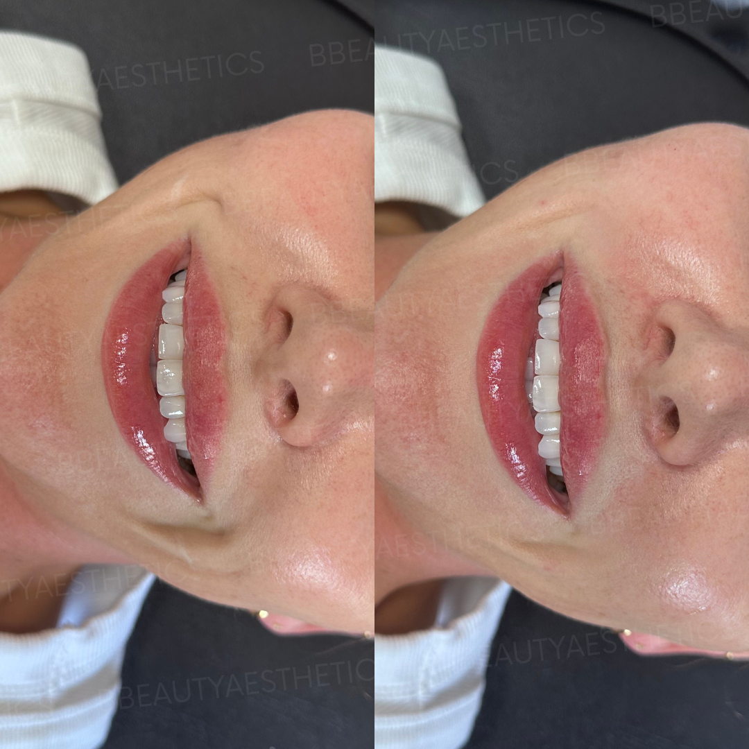 Before and after comparison of a person's smile with filler.