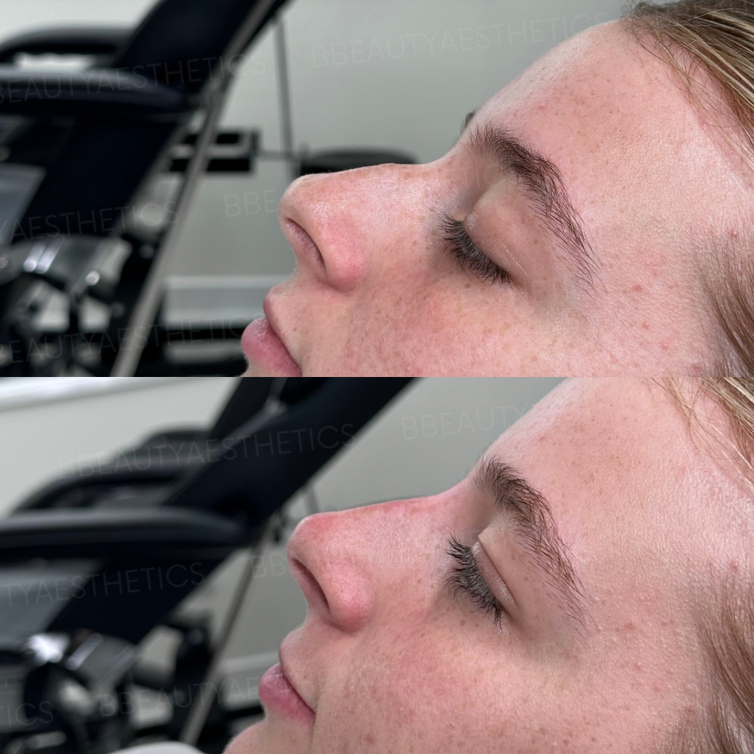 Before and after comparison of liquid rhinoplasty